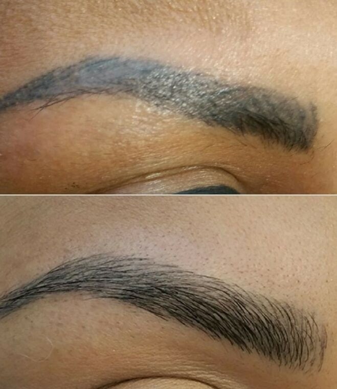 MICROBLADING REMOVAL