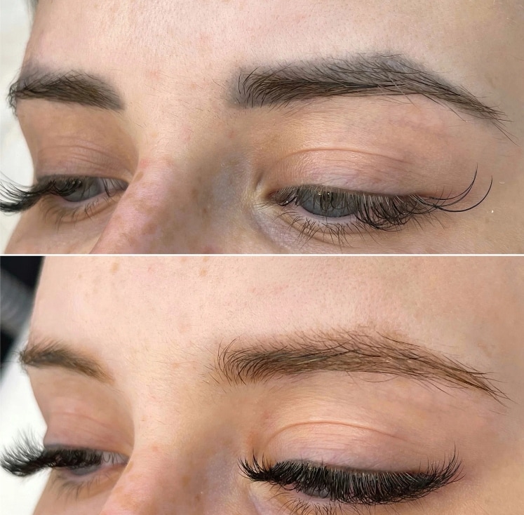 Permanent Makeup Removal Before After Picture