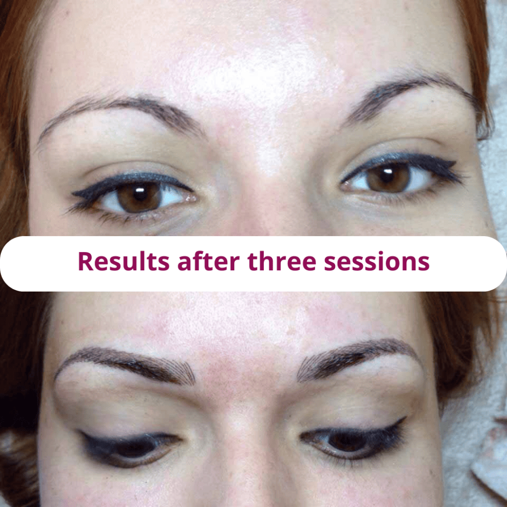 Eyeliner, laser removal photo before and after NY