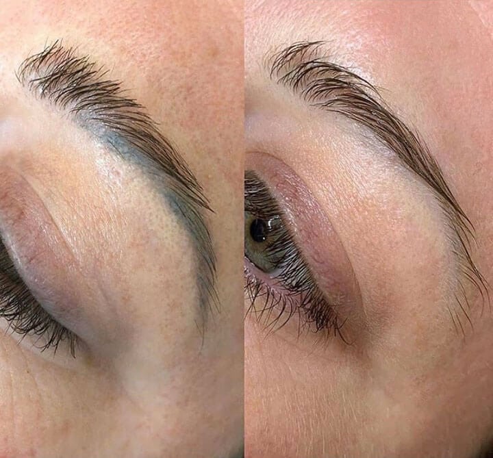 Chemical Microblading Removal