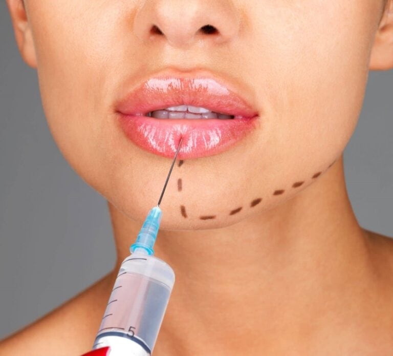 Lip injections, lip augmentation - Queens, NY