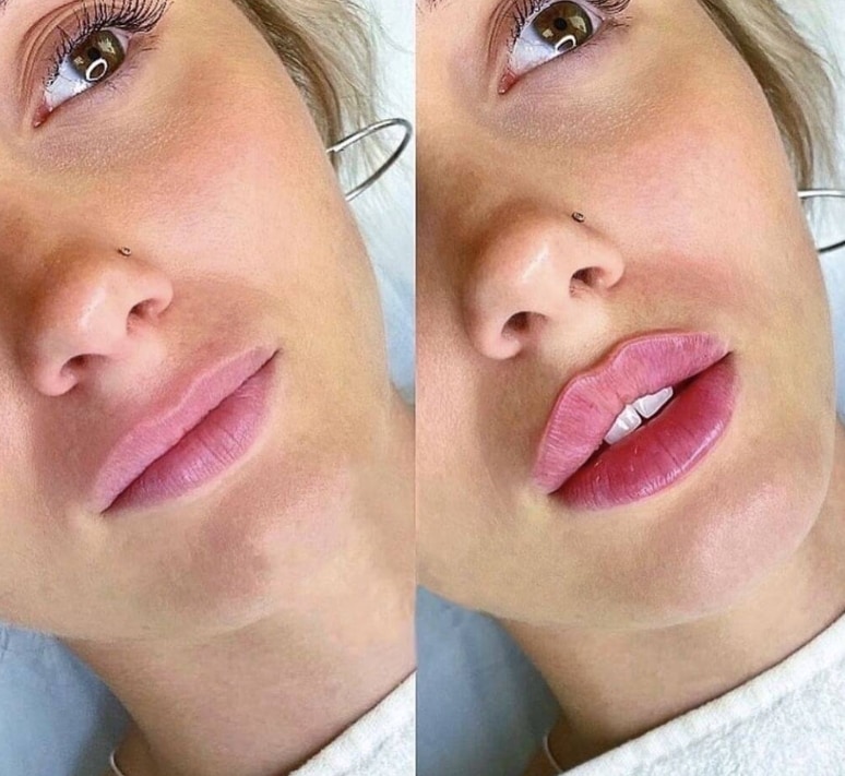 Lip injections, lip augmentation - Queens, New York,