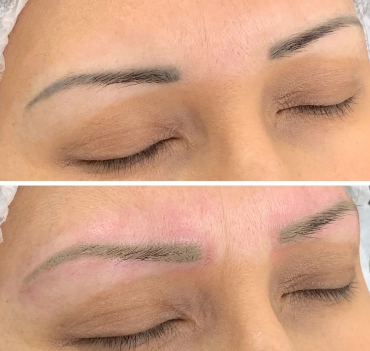 PERMANENT MAKEUP REMOVAL eyebrow makeup and microblading, before and after NY
