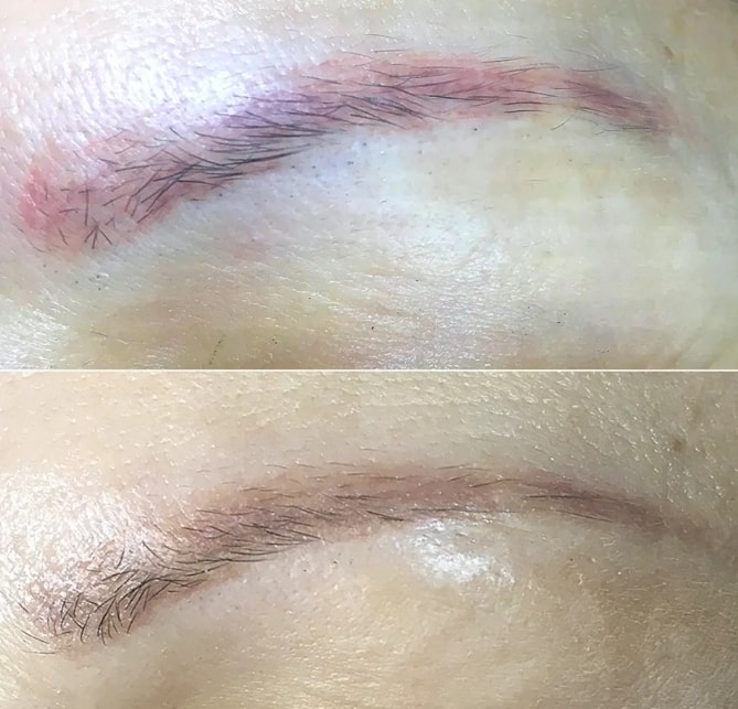 Removal of microblading with saline solution