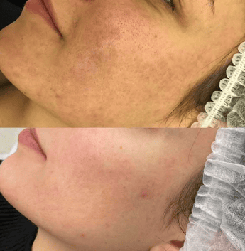 carbon peel before / after 2