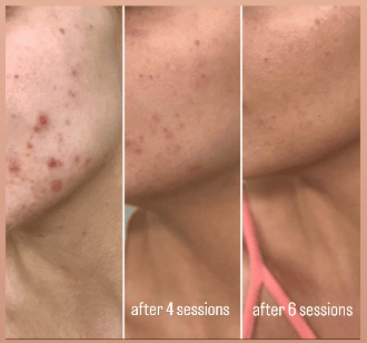 carbon peel before after