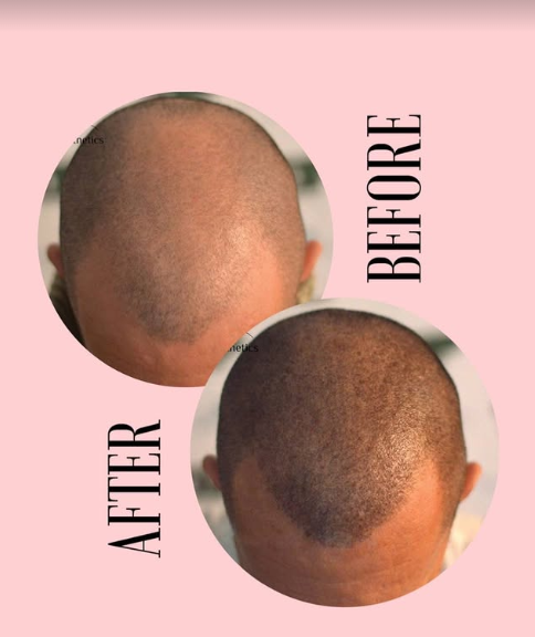 Scalp micropigmentation before and after 1