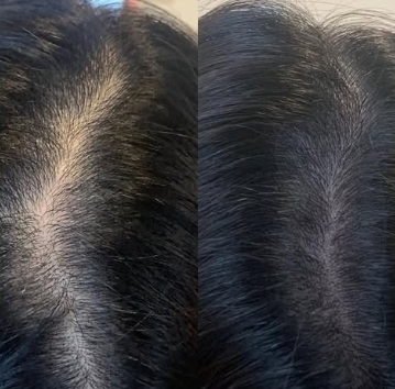 Scalp micropigmentation for women before and after