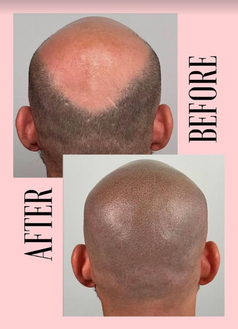 Scalp micropigmentation for men before and after