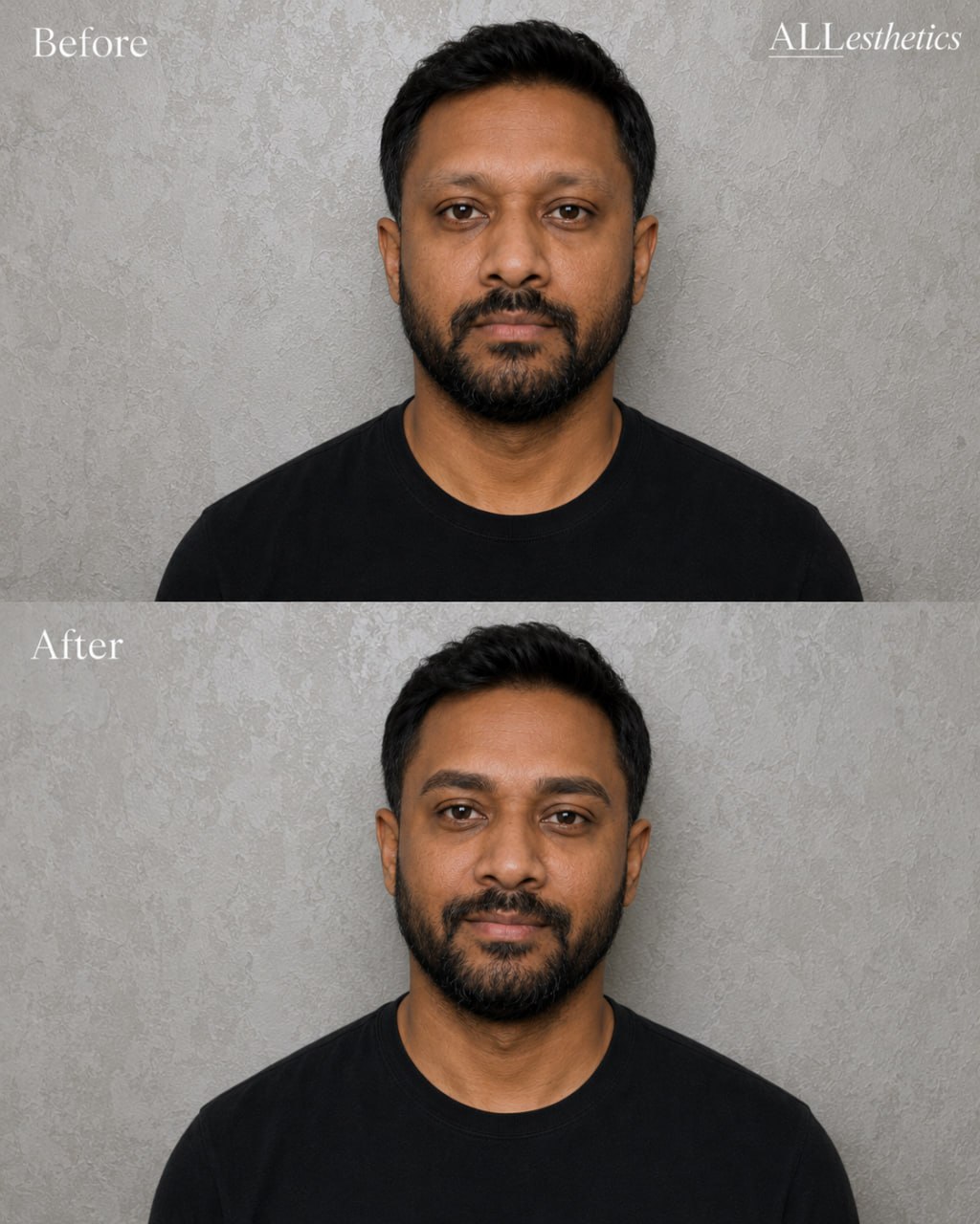menEyebrowMicroblading-beforeafter1