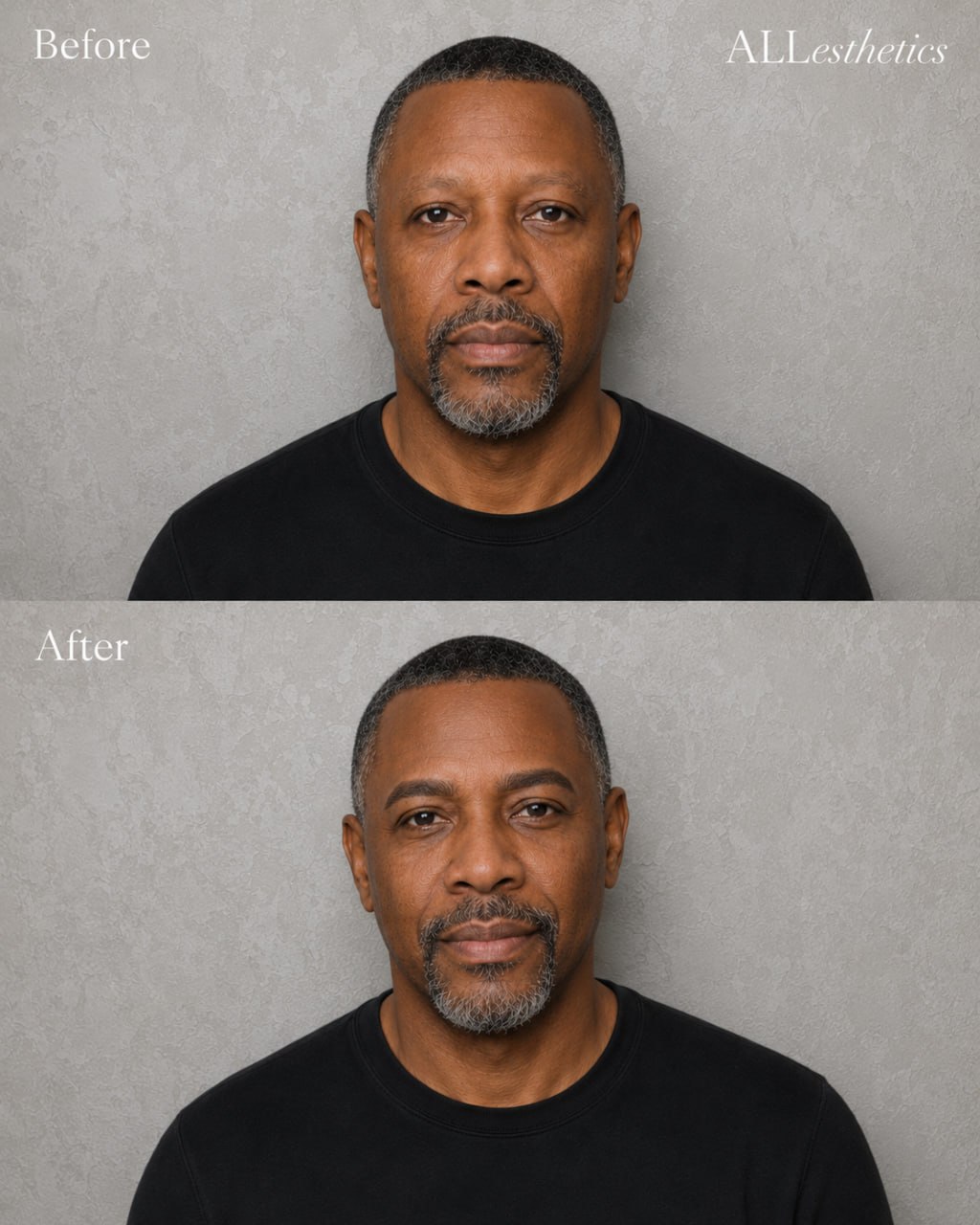 menEyebrowMicroblading-beforeafter8