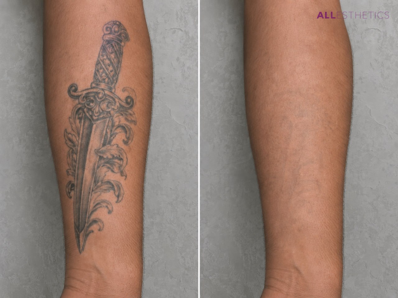 tatoo-removal1