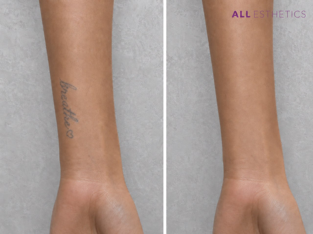 tatoo-removal10