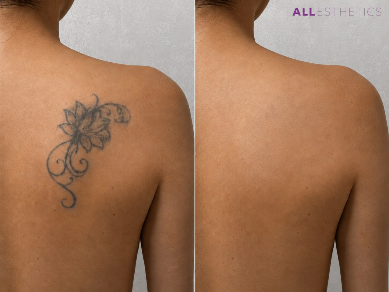 tatoo-removal2