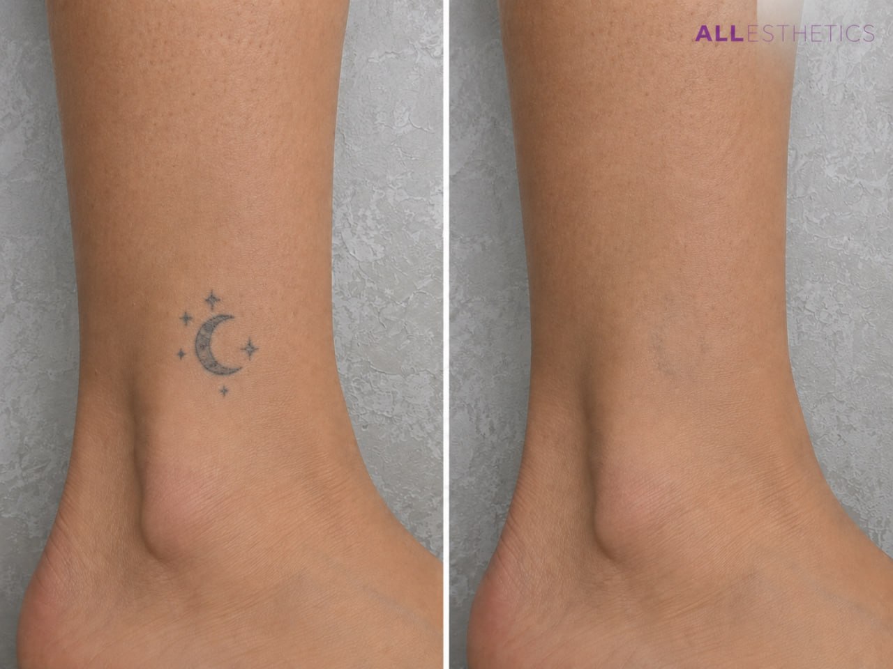tatoo-removal3