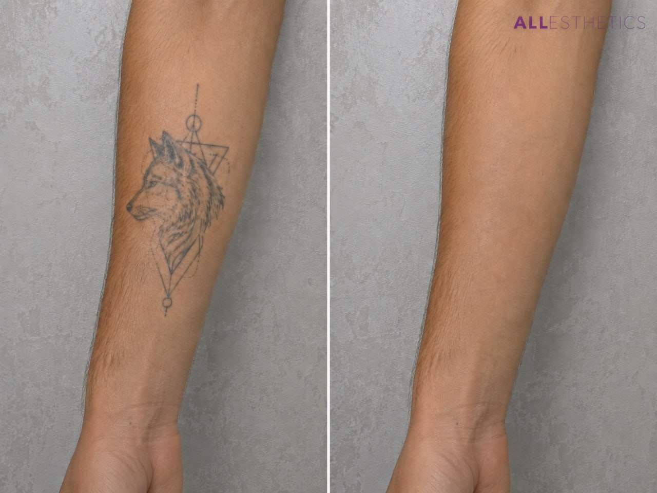 tatoo-removal4