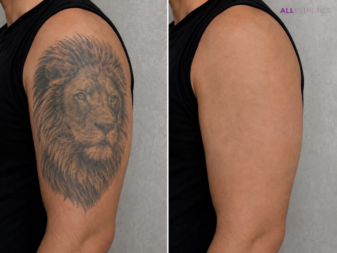 tatoo-removal5