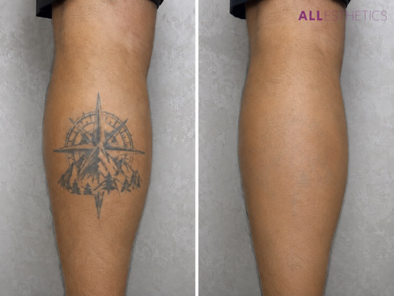 tatoo-removal6