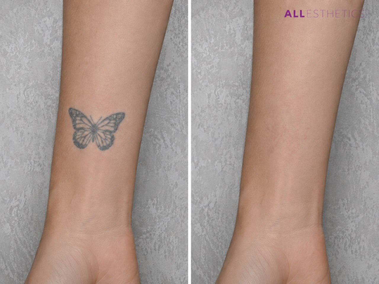 tatoo-removal7