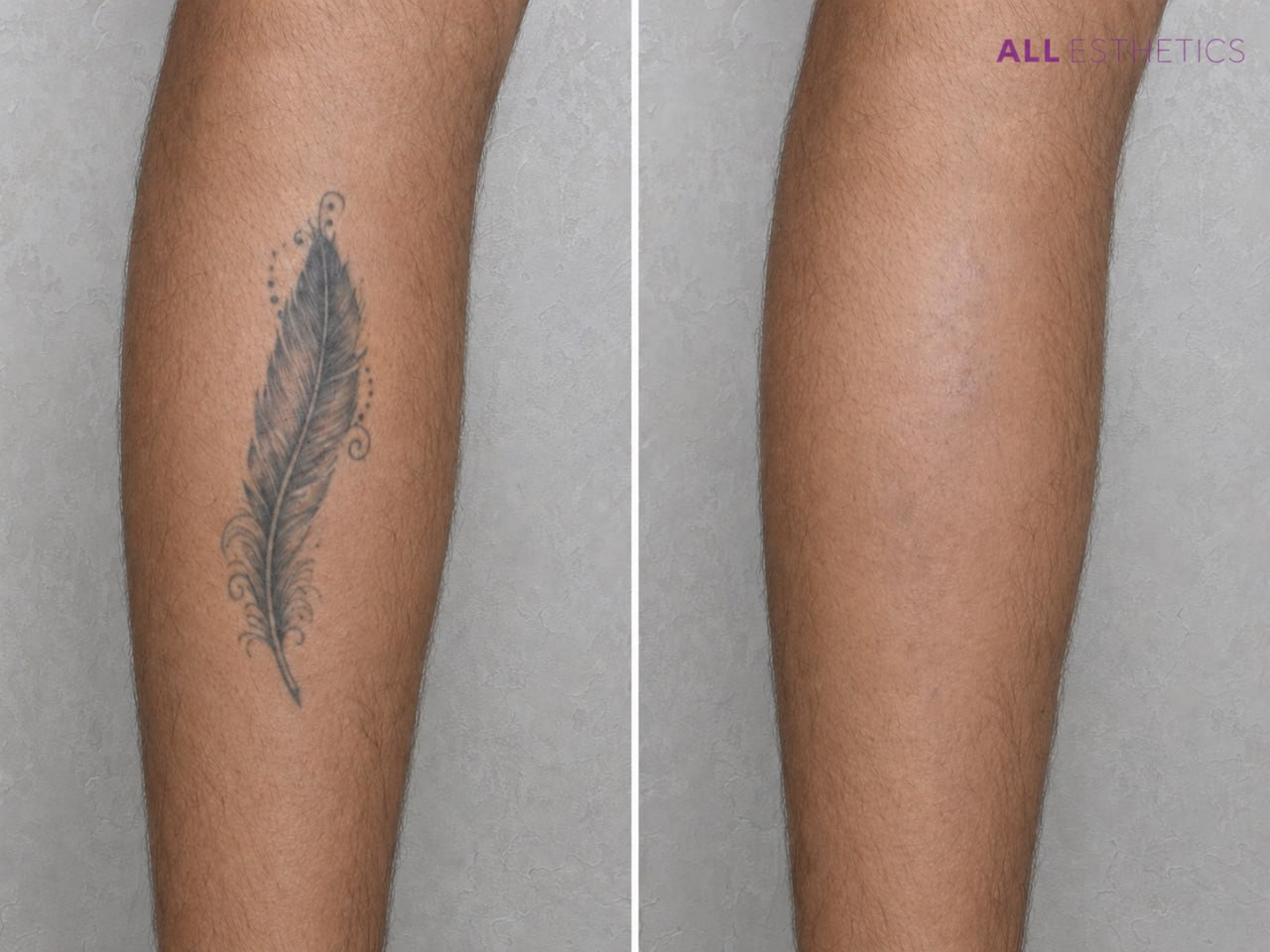 tatoo-removal8