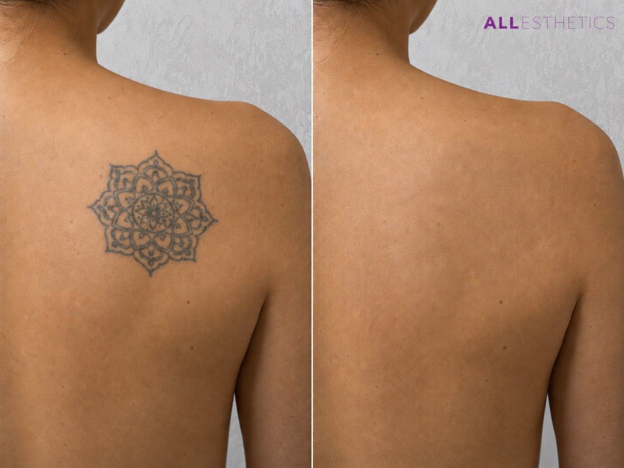 tatoo-removal9