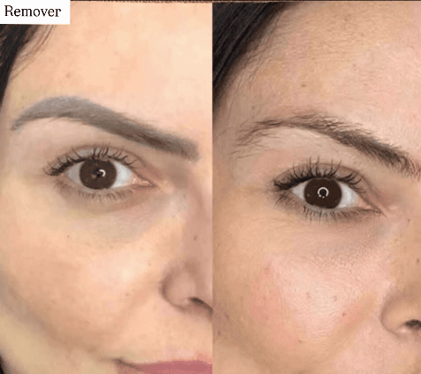microblading removal - before, after