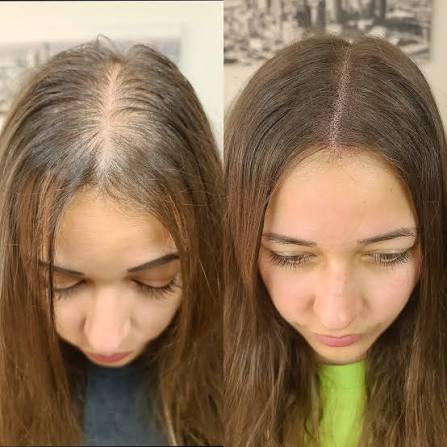 Female scalp micropigmentation before and after treatment for crown thinning