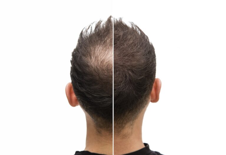 Hair Transplant