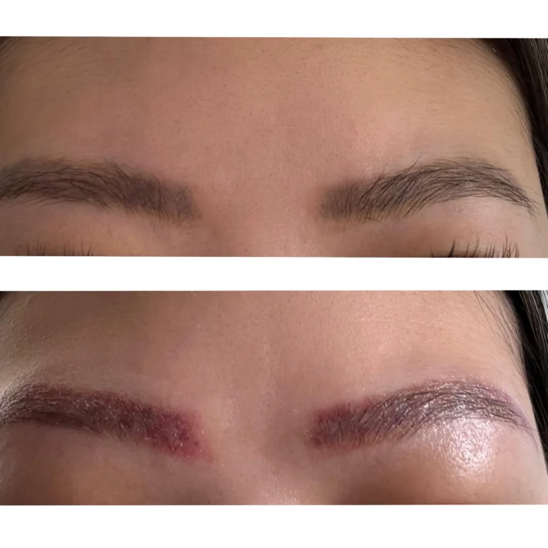 Eyebrow Tattoo Removal Turn Red