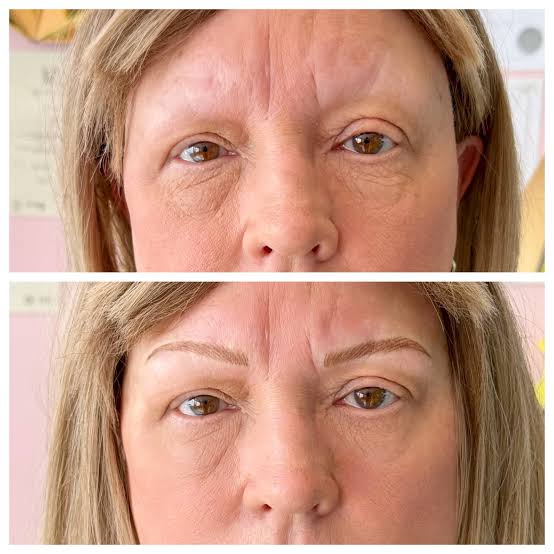 Microblading for Alopecia 1